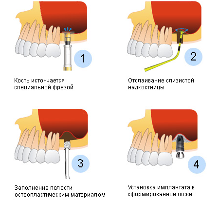 синус-лифтинг